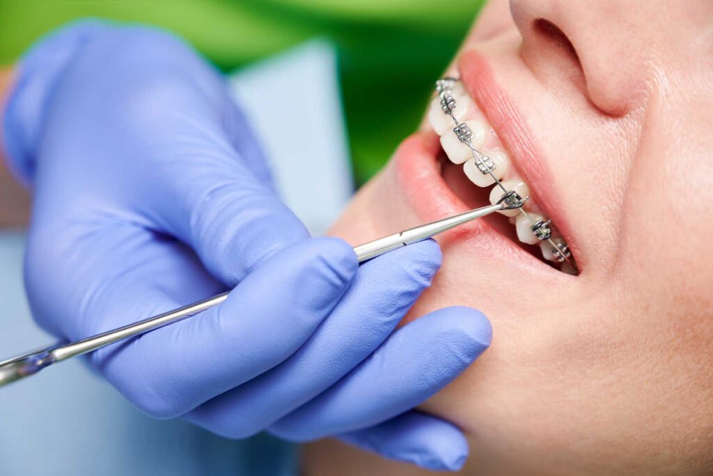 dental-braces-cost-in-chennai