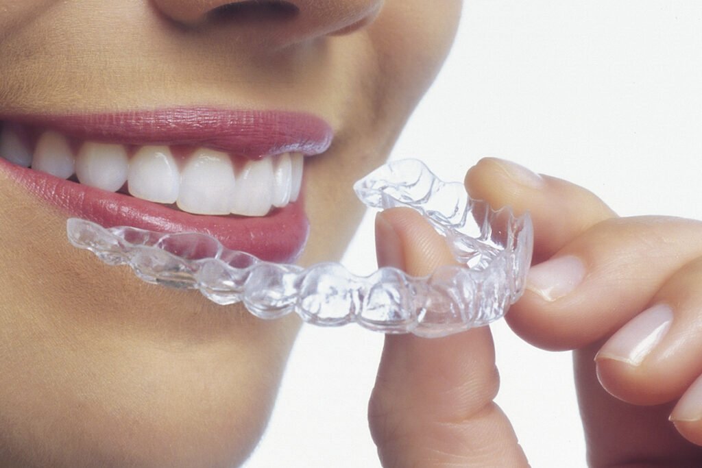 invisible-braces-price