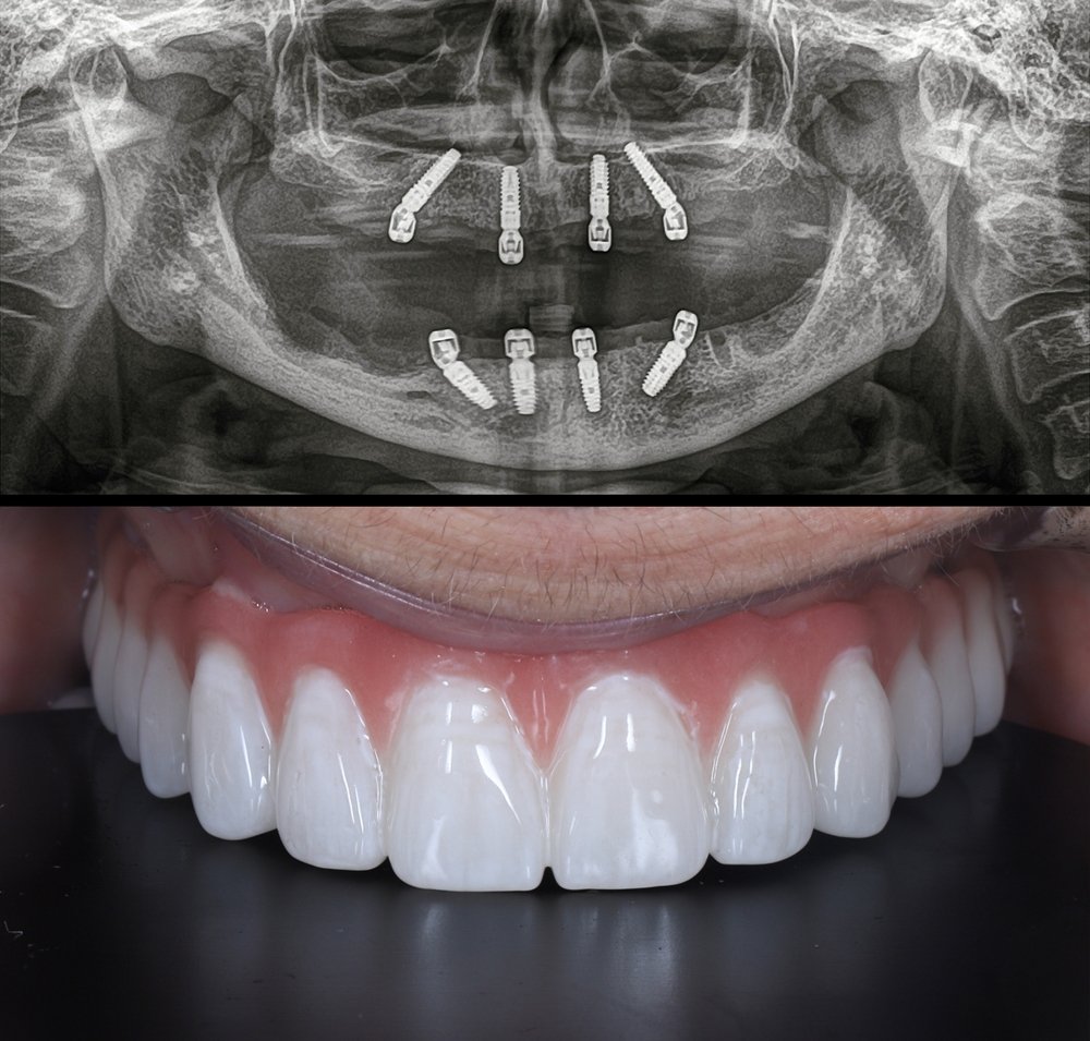 full-mouth-dental-implants-chennai-cost